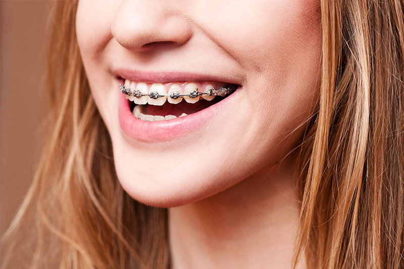 Orthodontics - A' Dentistry, Fullerton Dentist